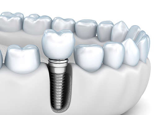 インプラント治療とは、失った歯の代わりに人工の歯を入れること