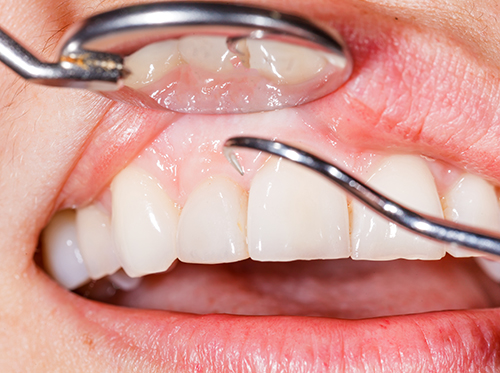 歯周病のメカニズムと原因について